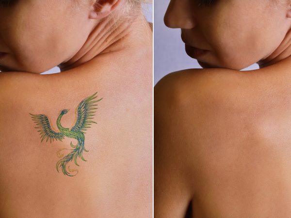 The Surprising Benefits To Gain From Removing Tattoos Using Laser Treatments